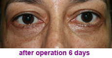 plastic-surgery-blepharoplasty